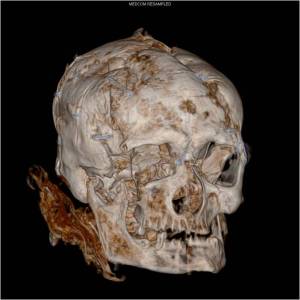 CT scan of Worsley Man (courtesy of Manchester Hospitals Judith Adams)